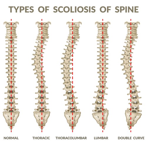 Scoliosis and Chiropractic Care