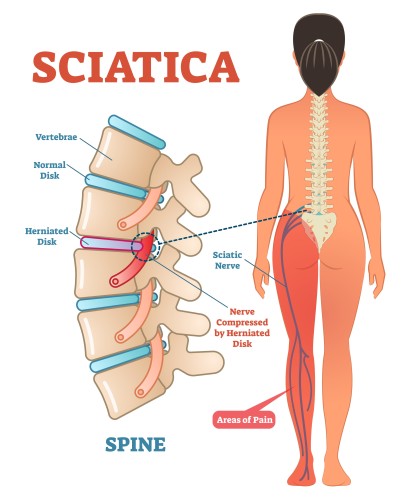 Let’s Talk about Sciatica