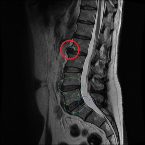 Should I have an MRI or X-ray of my back?