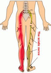 How do I stop sciatica?!