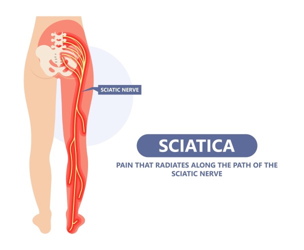 Understanding Sciatica: How Guildford Chiropractors Can Help Relieve the Pain